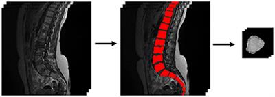 Improving classification results on a small medical dataset using a GAN; An outlook for dealing with rare disease datasets